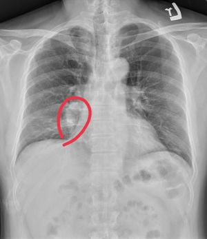▲蘇一峰圈出肺癌位置（紅圈處），感嘆「這個X光要發現肺癌真的很難」。（圖／翻攝蘇一峰臉書）