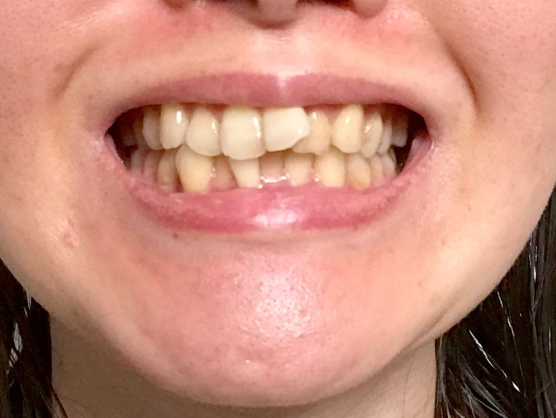 ▲一名年輕女性沒有蛀牙，但咬合時右下小臼齒卻很不舒服，就醫後發現是「畸形中央尖」，需根管治療。（示意圖，非當事人／取自PhtoAC）