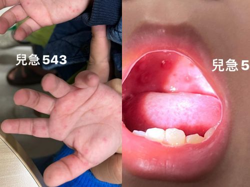 ▲感染腸病毒的病童幾乎都有典型的手足口病症狀，即在口腔、手足部出現如針頭大的紅點疹子水泡。（圖／翻攝來講兒科急診的543-吳昌騰醫師臉書）
