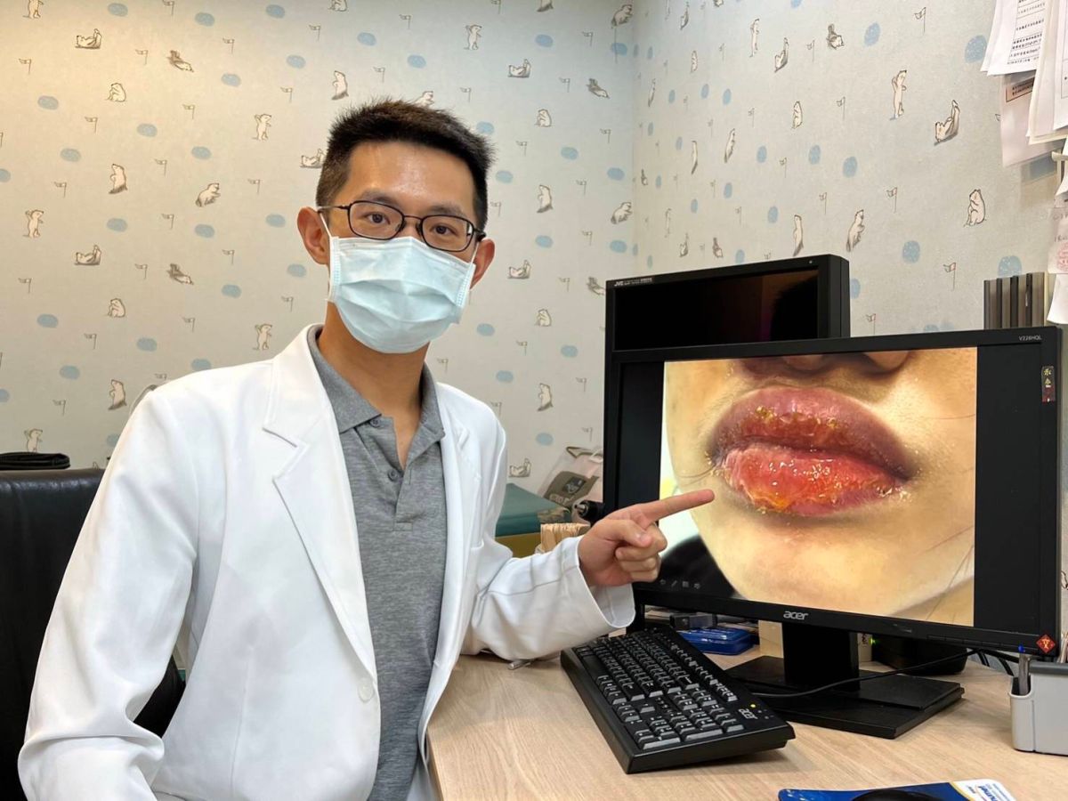 ▲10歲孩童出現嘴唇周圍疼痛和流膿病症，就醫後發現為「膿痂疹」。（圖／書田診所提供）