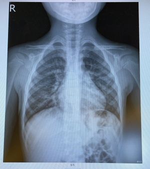 ▲4歲童照X光後確診肺炎，發現是由hMPV（人類間質肺炎病毒）感染引發。（圖／翻攝林智葳臉書）