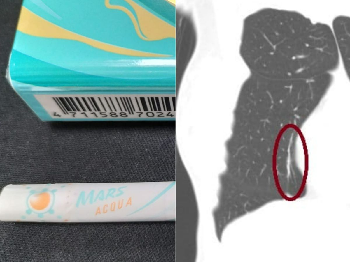 ▲蘇一峰分享，30歲女病患愛抽爆珠香菸，近日因咳嗽不停就診，發現肺部已塌陷。（圖／翻攝蘇一峰臉書）