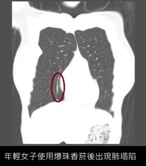 ▲蘇一峰分享30歲女病患肺部電腦斷層照。（圖／翻攝蘇一峰臉書）