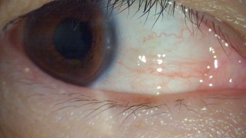 ▲「黑矇症」會讓視力出現陰影或模糊，甚至是完全失明，但不會引起疼痛，主要原因是「視網膜血流受阻」。（圖／NOWNEWS資料照）