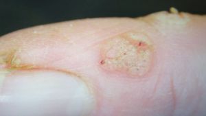 ▲右手有兩處類似潰瘍的傷口，上面有出血點，患者以為是濕疹。（圖／達特楊眼科聯盟提供）