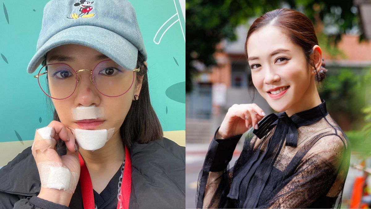 ▲楊千霈日前傳出重摔水泥地，臉部嚴重破相，一度血流不止，讓外界心疼。所幸，楊千霈向《NOWnews今日新聞》曝光目前的痊癒狀況：「已經好很多了啦！」（圖／楊千霈提供）