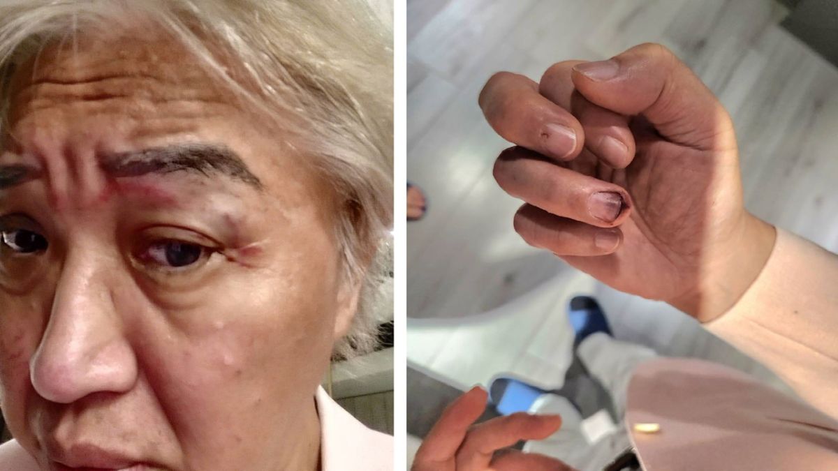 ▲鄭為元出示照片說明，雙方發生衝突當天，自己也有多處受傷。（圖／鄭為元提供）