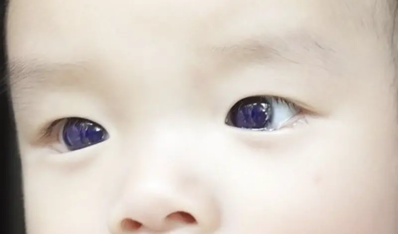 ▲泰國男嬰服用抗病毒藥物治療新冠肺炎後，眼睛竟然從棕色變成亮藍色。（圖／翻攝自frontiersin.org）