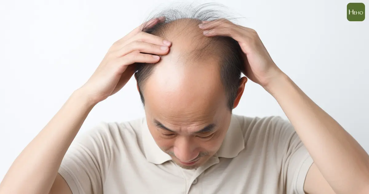 ▲「圓形禿」與一般禿頭不同！嚴重連眉毛、睫毛也會掉落