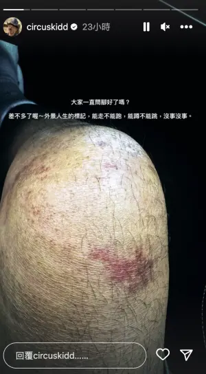 ▲KID曬出膝蓋上的瘀青傷口，表示傷勢已經復原得差不多了。（圖／翻攝自KID IG）