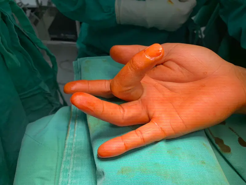 ▲板機指好發於常需使用手指工作的族群，如果手指疼痛、卡住動不了，很可能就是板機指。（示意圖／中正脊椎骨科醫院提供）