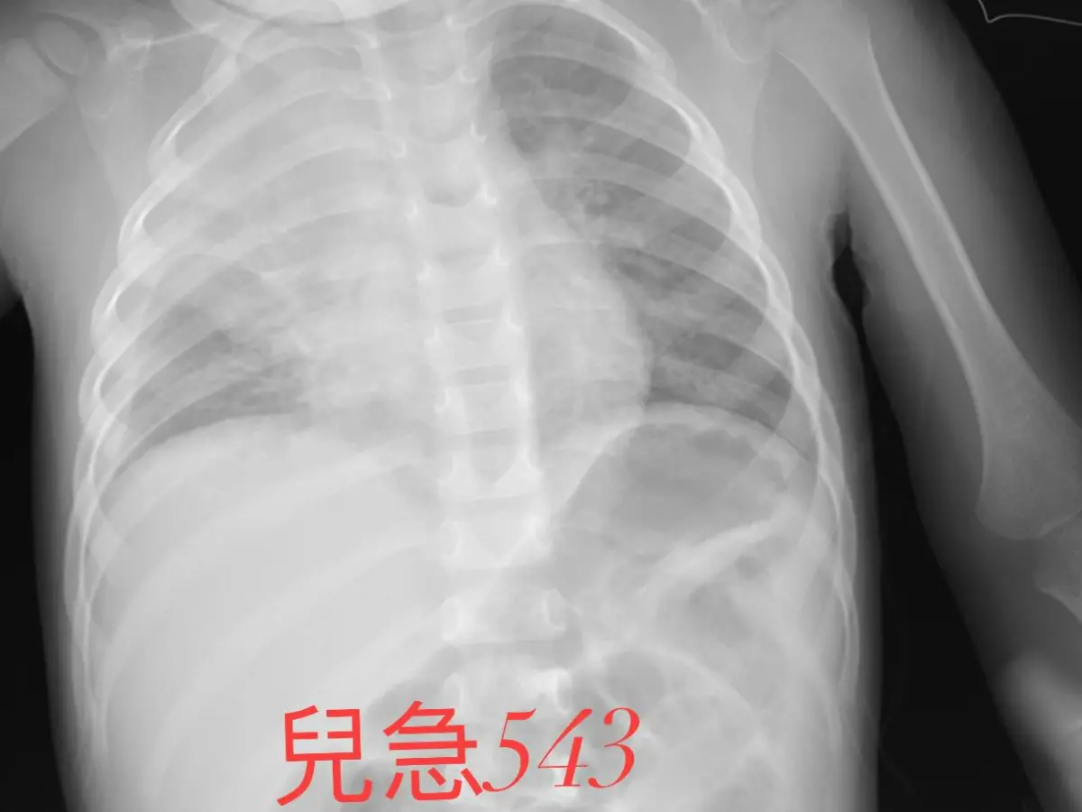 ▲小兒科醫師吳昌騰指近來兒科急診病人暴增，不少病毒正流行著，尤其是RSV，嚴重會引發肺炎（如圖），甚至導致嬰兒猝死。（圖／翻攝來講兒科急診的543-吳昌騰醫師臉書）