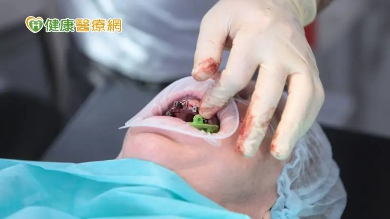 ▲人工牙根掉入鼻竇　口外內視鏡手術急救