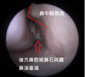 ▲一些黏稠鼻涕後方塞滿了一坨黑黑的硬塊」，這塊觸不到的鼻屎，就是造成患者不適的主要原因。（圖／取自陳亮宇耳鼻喉科診所臉書）