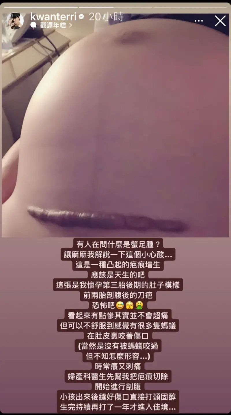 ▲關穎公開剖腹的蟹足腫傷口，畫面相當驚悚。（圖／關穎IG）