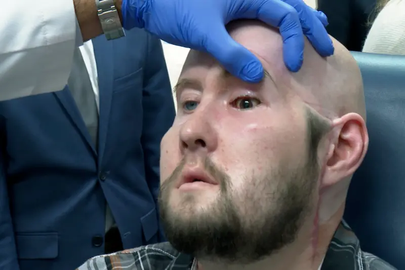 ▲美國退伍軍人詹姆斯，今年5月在紐約接受臉部局部及左眼全眼移植手術。（圖／美聯社／達志影像）