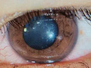 ▲積極治療兩周後，左眼病變均已長好，最佳視力回到0.9。（圖／達特楊眼科聯盟提供）