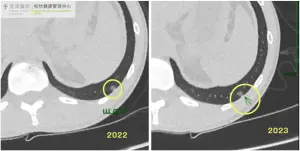 ▲ 肺部影像發現的異常病灶沒變大，靠切片檢查才抓到早期肺癌。（圖／柏忕健康管理中心提供）