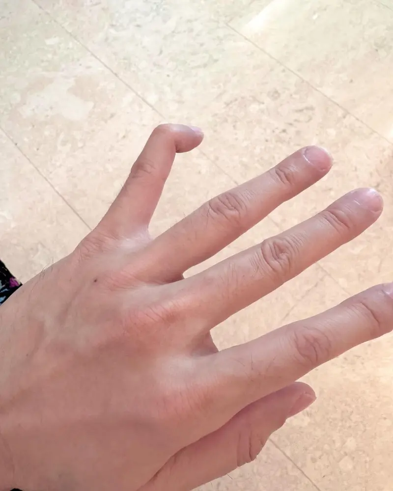 ▲林俊傑小拇指的指節成90度彎曲，畫面怵目驚心。（圖／林俊傑IG）