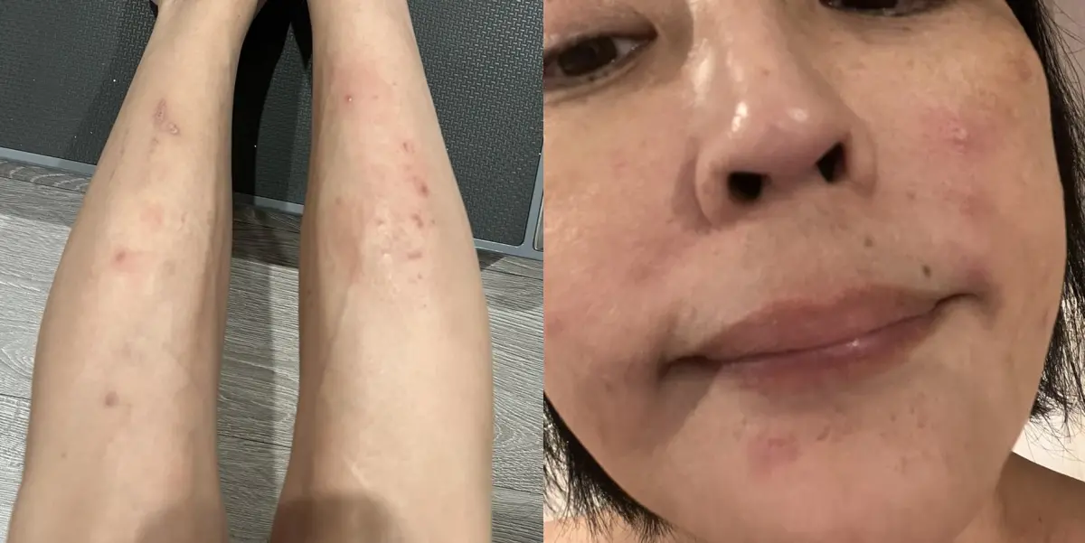 ▲罹患胃癌的唐玲打了流感疫苗後，全身出現紅疹，感嘆人生很坎坷。（圖／翻攝自唐玲FB）