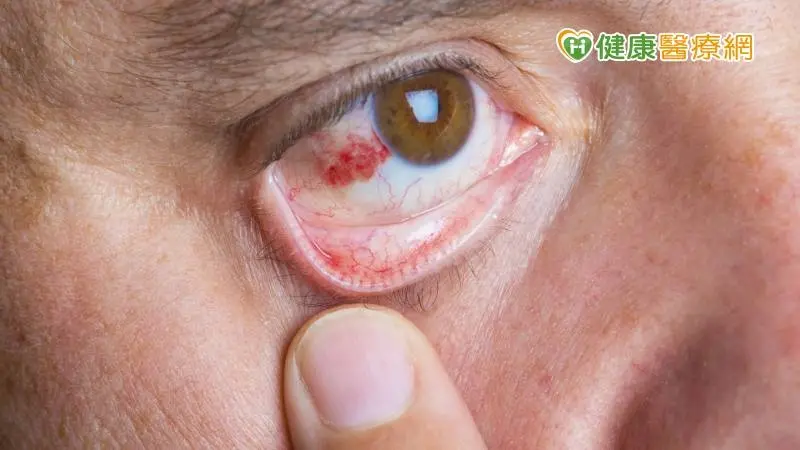 ▲眼睛紅紅的「結膜下出血」是中風前兆？　眼科醫破解迷思