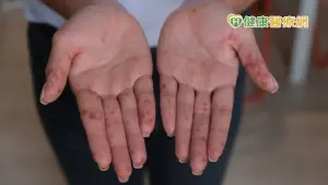 20多歲女雙手佈滿紅疹怵目驚心　竟是大人腸病毒
