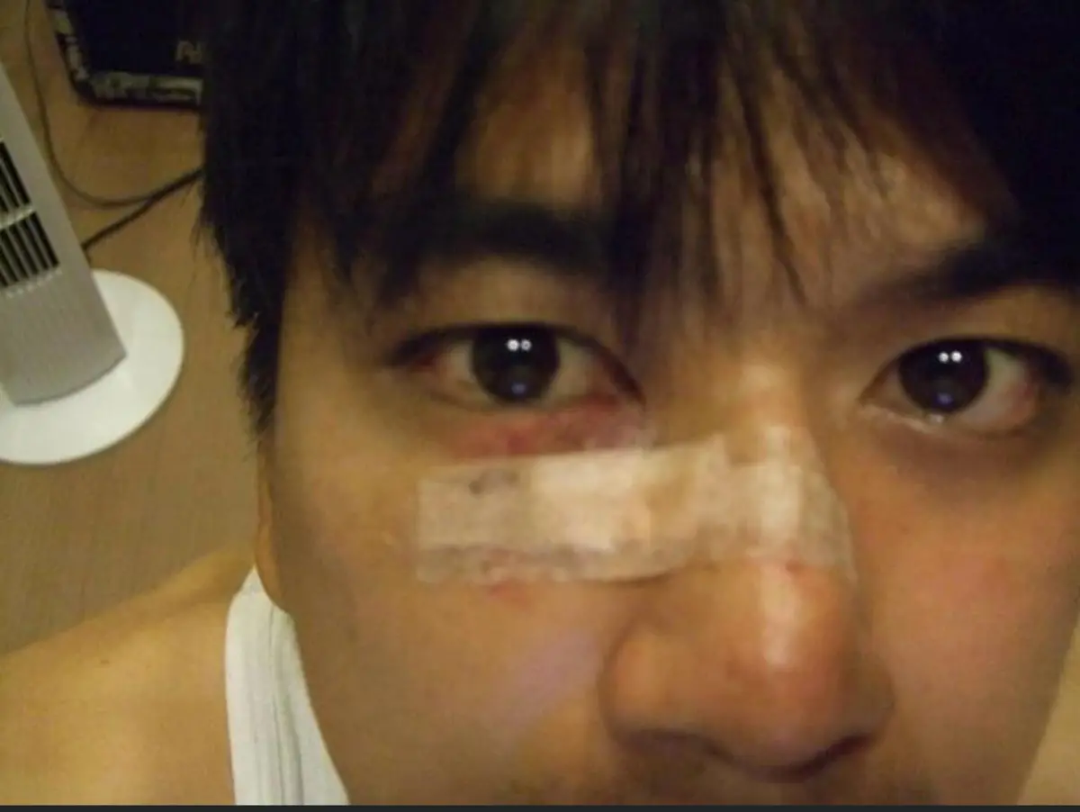 ▲潘逸安拍武打戲被斷棍劃裂鼻樑，險傷及雙眼陷失明危機。（圖／艾迪昇傳播提供）