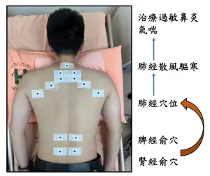 ▲三九貼治療原理。（圖／聯合醫院提供）