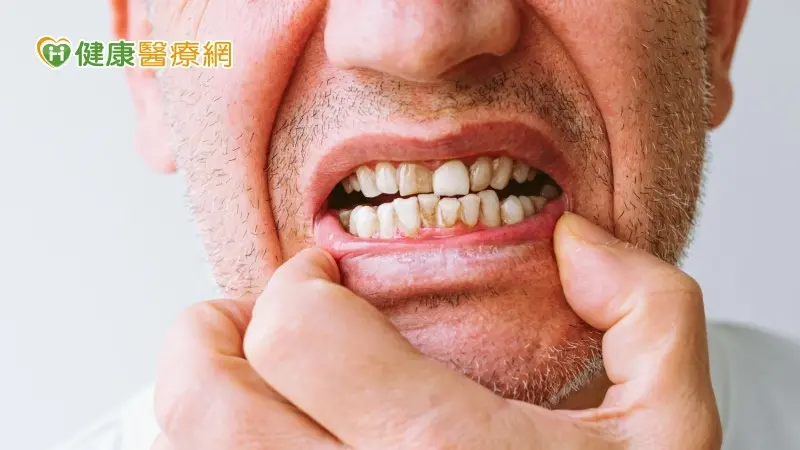 ▲他嚴重牙周病戴活動假牙食物咬不爛　「1招」解噴假牙、咀嚼卡卡困擾