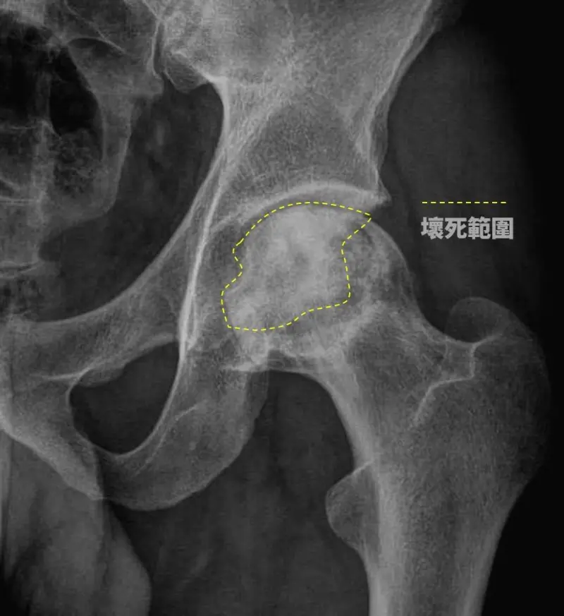 ▲男性患者因長期飲酒而在行走時感到髖部疼痛，透過X光拍攝出現「股骨頭缺血性壞死」情形（圖／朴子醫院提供）
