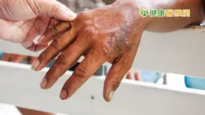 醫籲：痲瘋病應去汙名化！　台年僅十例
