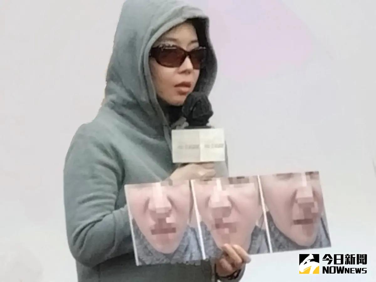 ▲美容老師林小姐為了消除法令紋，跟著網路揪團一起做醫美，卻疑似用到假貨。（圖／記者林志怡攝，2024.01.18）