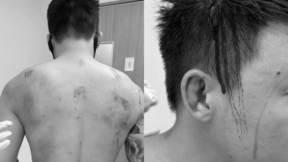 ▲Toyz「頭頂縫十幾針」，嚴重傷勢照曝光。（圖／取自林一泓臉書）