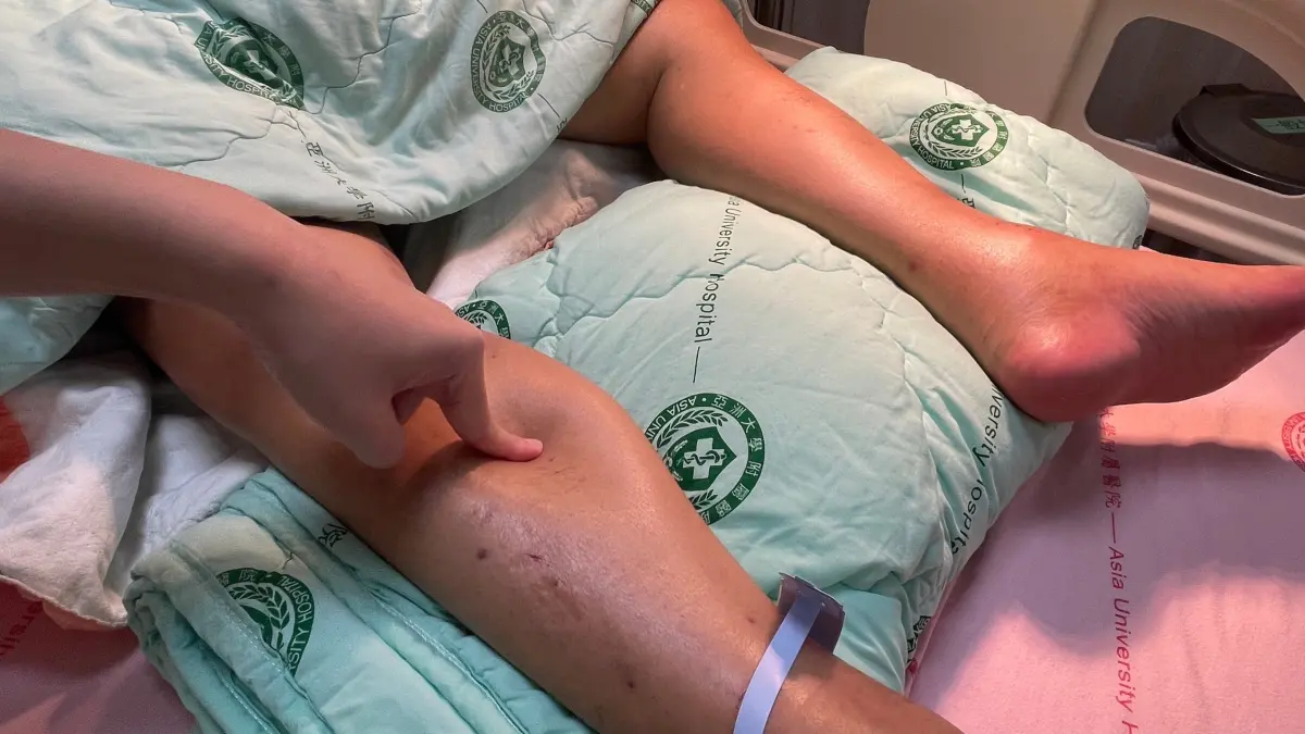 ▲患者因莫名下肢水腫就醫，才發現竟然罹患紅斑性狼瘡。(圖／非當事人醫院提供2024.1.25)