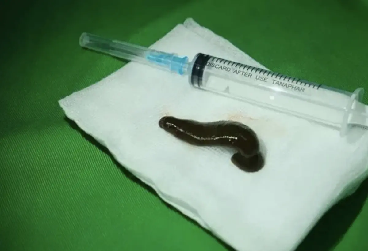 ▲一名越南男子覺得喉嚨不舒服，就醫檢查發現，裡面卡了一隻6公分的活水蛭。（圖／翻攝自vnexpress）