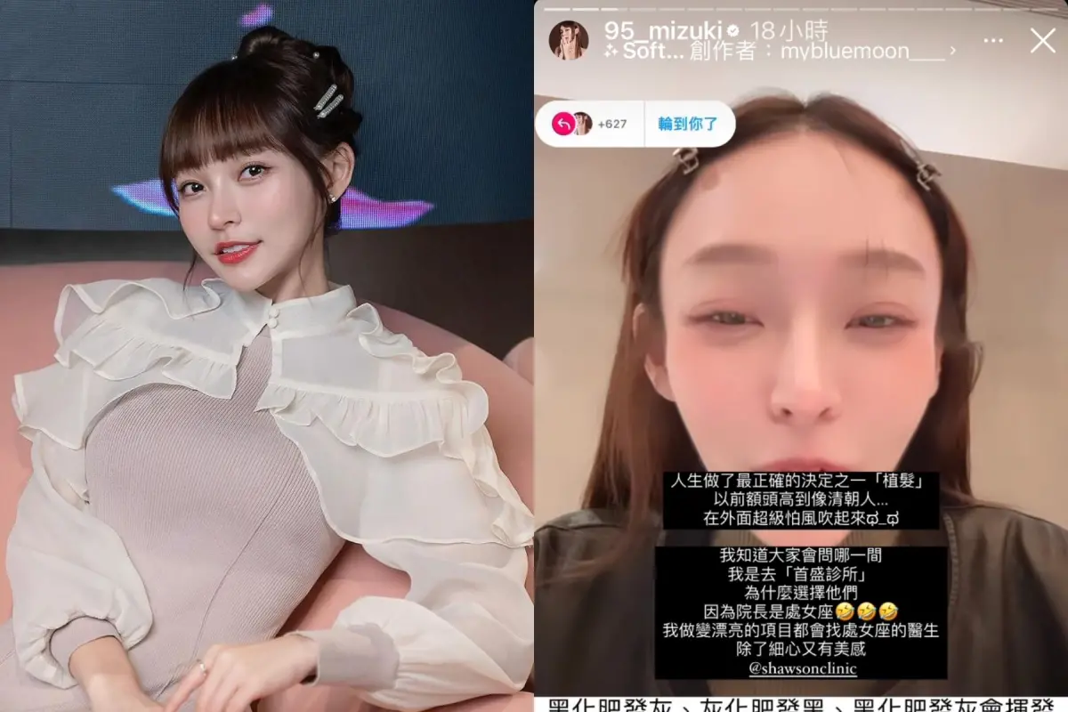 ▲林襄坦承因額頭太高去植髮，她曬出植髮前掀瀏海的模樣，自嘲像是「清朝人的額頭」，還曝光術後對比照。（圖／記者陳明中攝影）