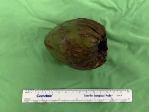 ▲椰子大小長7.5公分、底部5.7公分。（圖／義大醫院提供）