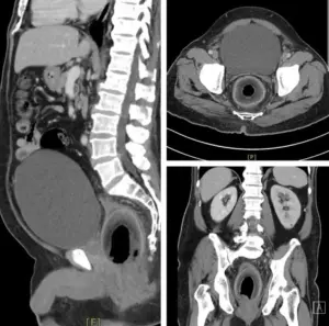 ▲電腦斷層掃描發現，直腸內有一顆椰子。（圖／翻攝British Journal of Surgery）