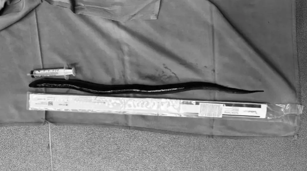 ▲醫生從男子腹部取出30公分長的活鰻魚。（圖／越南海河縣醫療中心）