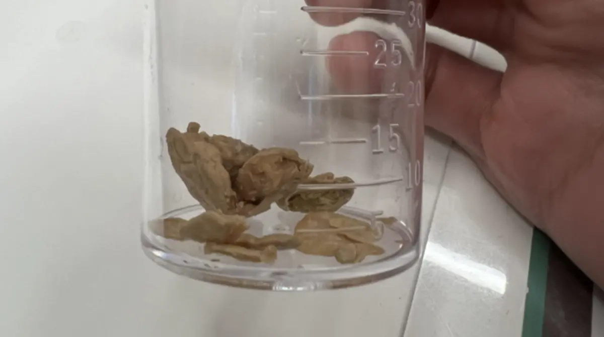 ▲中部一位男子，在家中上廁所時，突然發現生殖器掉出一片片「黃色石塊」，讓他嚇得急忙就醫。（圖／陳昭安醫師提供）