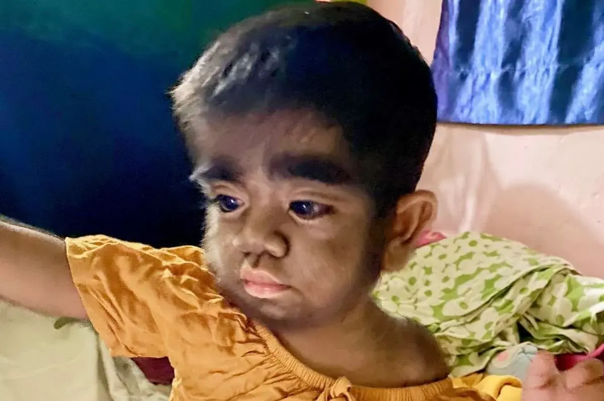 ▲一名孕婦在懷孕期間吃了一隻黑貓，沒想到生下小孩後，孩子竟罹患罕見多毛疾病。（圖／翻攝自每日星報）