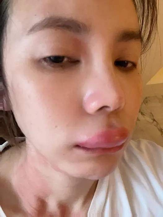 ▲▼王偊菁感染急性蕁麻疹，嘴唇腫脹，自認像梁朝偉在《東成西就》中的「西毒」歐陽鋒角色。（圖／王偊菁臉書）