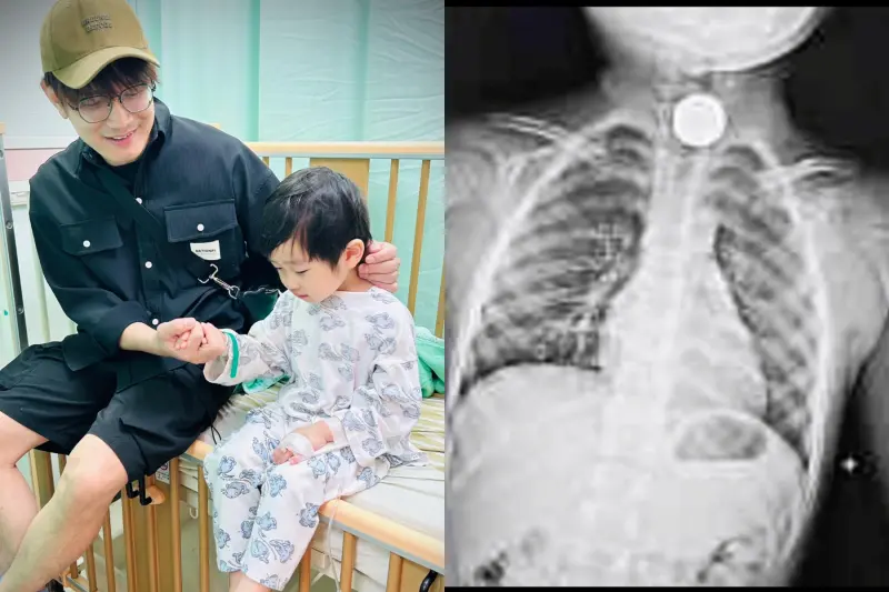 金曲歌王4歲兒「吞硬幣卡喉嚨」！X光片好驚悚　全身麻醉才取出