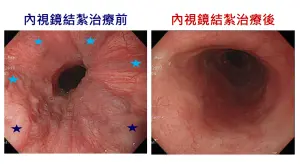 ▲男子6條（深藍星號為中型、淺藍星號為小型）食道靜脈曲張，經內視鏡結紮治療後未再復發。（圖／北榮提供）