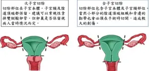 ▲次全子宮切除術可保留子宮頸，術後可望保有較佳生活品質。（圖／北醫附醫提供）