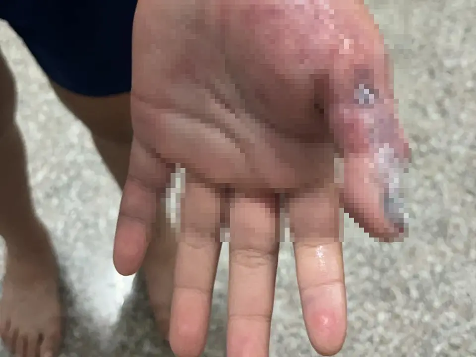 ▲雲林一名小六女童因未交作業遭安親班老師過度體罰，導致左手出現大量淤青。（圖／翻攝畫面）