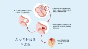 ▲左心耳封堵器可有效預防腦中風的發生。（圖／振興醫院提供）