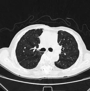 ▲經標靶治療後，電腦斷層顯示肺部轉移病灶已完全消失。（圖／花蓮慈濟醫院提供）