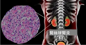 ▲平均每顆腎臟裡約有100萬顆腎絲球,若未妥善治療恐導致末期腎衰竭。(圖/北市聯醫提供) ▲平均每顆腎臟裡約有100萬顆腎絲球,若未妥善治療恐導致末期腎衰竭。(圖/北市聯醫提供)