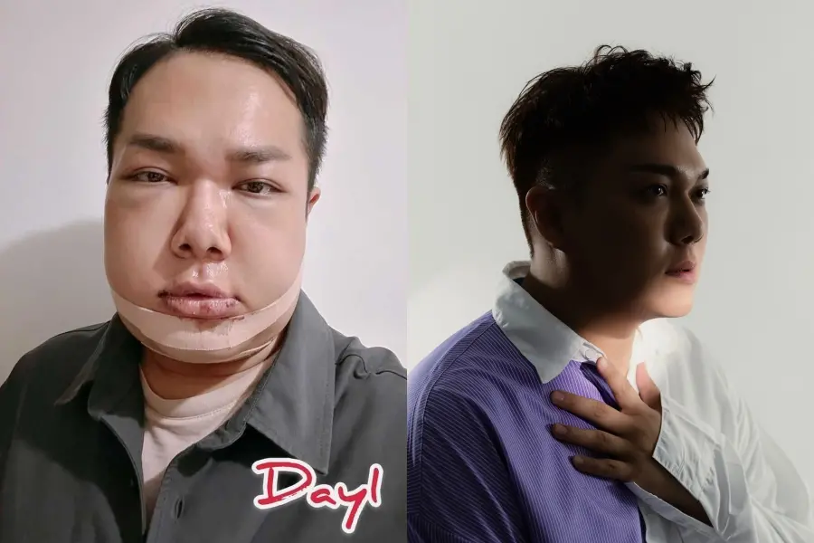 ▲關韶文砸50萬進行正顎手術，看到自己術後「豬頭腫臉」的模樣，都讓他情緒數度失控、在家爆哭。（圖／時報出版提供）